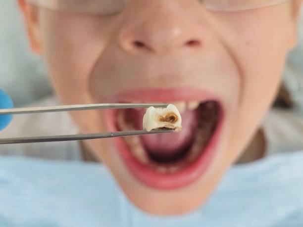 Best Urgent Tooth Repair  in Tye, TX