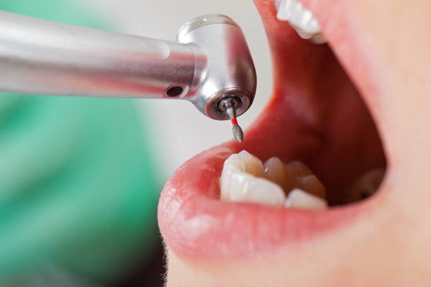 Best Dentist for Tooth Abscess  in Tye, TX